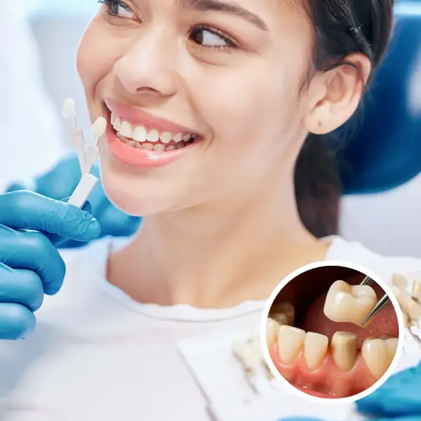 Dental Crowns at MS Dental