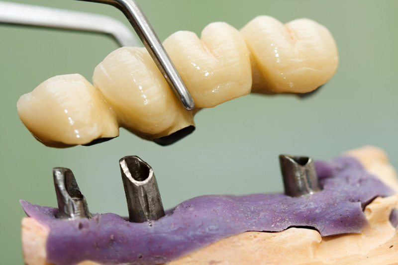 MS Dental - Maryland Bonded Bridges - Cardiff - Singleton - Fletcher - Newcastle