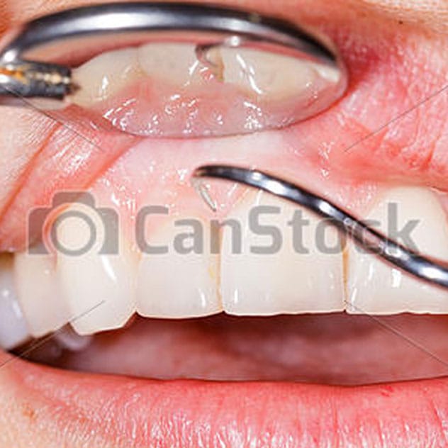 Gum Disease Gum Disease