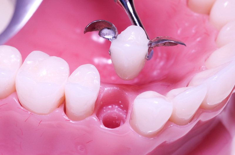 MS Dental - Cantilever Bridges - Cardiff - Singleton - Fletcher - Newcastle