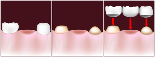 MS Dental - Process of Dental Bridge - Cardiff - Singleton - Fletcher - Newcastle