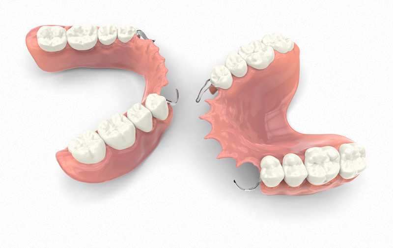 MS Dental - Removable Partial Dentures - Cardiff - Singleton - Fletcher - Newcastle