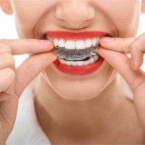 Invisible Braces in Cardiff, Singleton and Fletcher