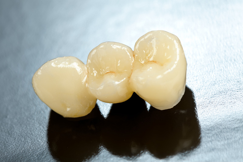 MS Dental - Traditional Bridges - Cardiff - Singleton - Fletcher - Newcastle