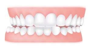 MS Dental - Crossbite - Cardiff - Singleton - Fletcher - Newcastle