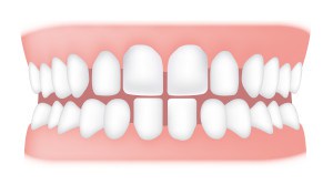 MS Dental - Large Gaps Between Teeth - Cardiff - Singleton - Fletcher - Newcastle