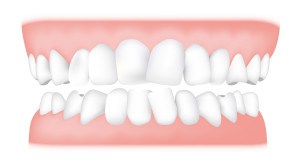 MS Dental - Overcrowding - Cardiff - Singleton - Fletcher - Newcastle