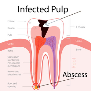 MS Dental - Root Canal Treatment - Cardiff - Singleton - Fletcher - Newcastle