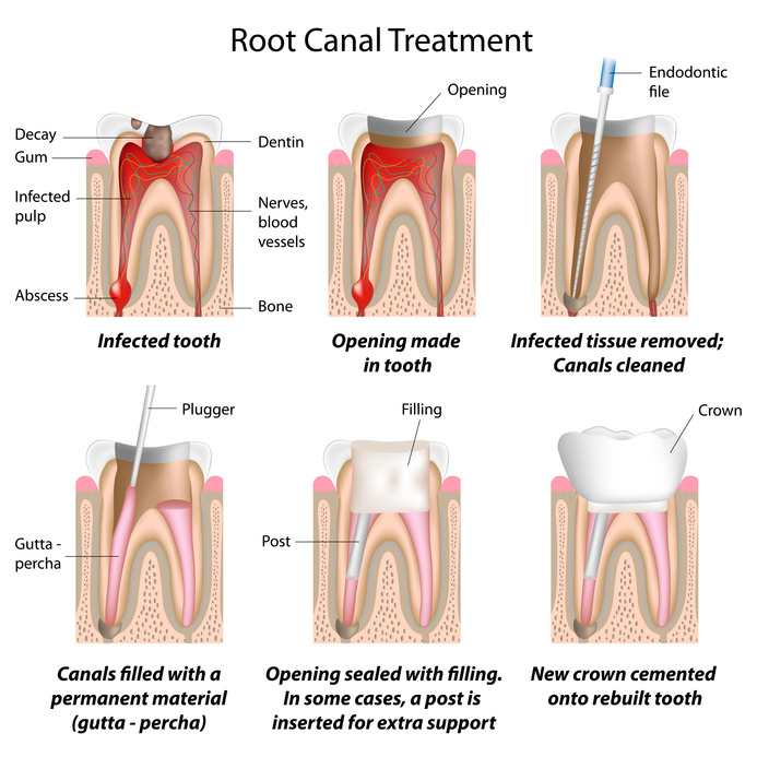 MS Dental - Procedure of Root Canal Treatment - Cardiff - Singleton - Fletcher - Newcastle