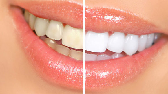 The Dangers of Buying Teeth Whitening Kits Online in Cardiff The Dangers of Buying Teeth Whitening Kits Online in Cardiff