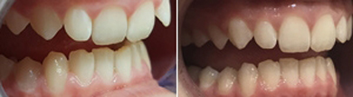 MS Dental - Invisible braces - Cardiff - Singleton - Fletcher - Newcastle