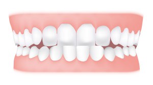 MS Dental - Underbite - Cardiff - Singleton - Fletcher - Newcastle