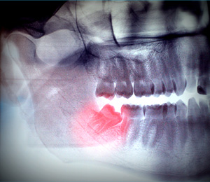 MS Dental - Wisdom Teeth - Cardiff - Singleton - Fletcher - Newcastle