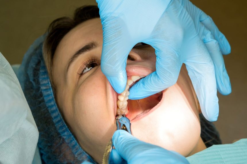 Wisdom Teeth Extractions