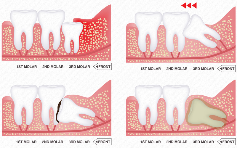 MS Dental - Issues that may arise due to wisdom teeth - Cardiff - Singleton - Fletcher - Newcastle