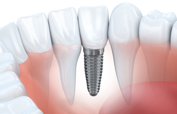 Single Tooth Replacement