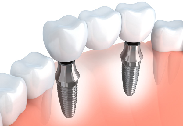 Multiple Tooth Replacement