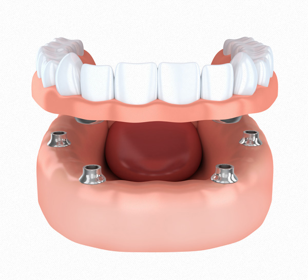Denture Replacement / Implant Support Dentures