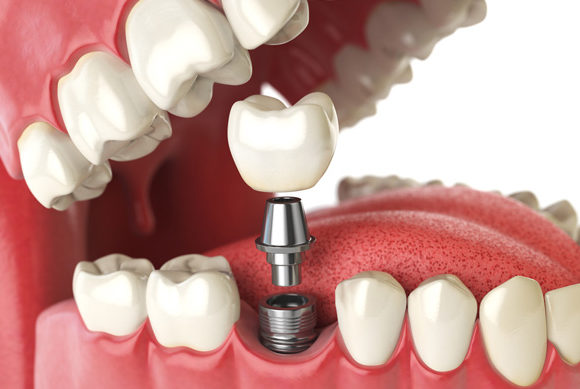 Implants