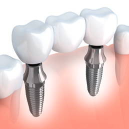 Dental Implant