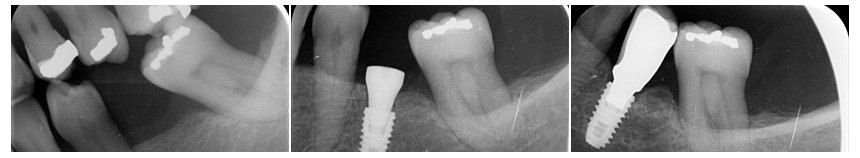 Dental Implant ex-ray