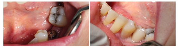 Dental implant