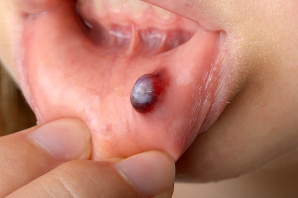Tongue bubble under Blood Blister