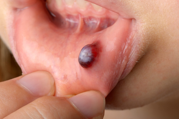 blood blister in mouth