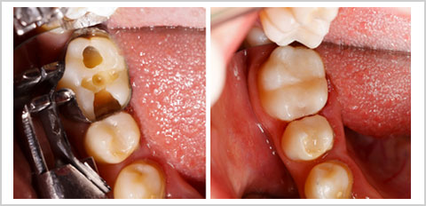 MS Dental - White Fillings - Cardiff - Singleton - Fletcher - Newcastle