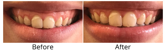 MS Dental - Gingivectomy gum reduction page - Cardiff - Singleton - Fletcher - Newcastle