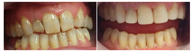 MS Dental - Dental Veneer - Cardiff - Singleton - Fletcher - Newcastle