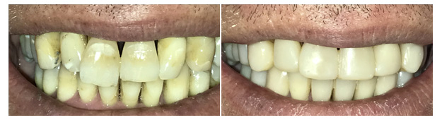 MS Dental - Dental Veneers - Cardiff - Singleton - Fletcher - Newcastle