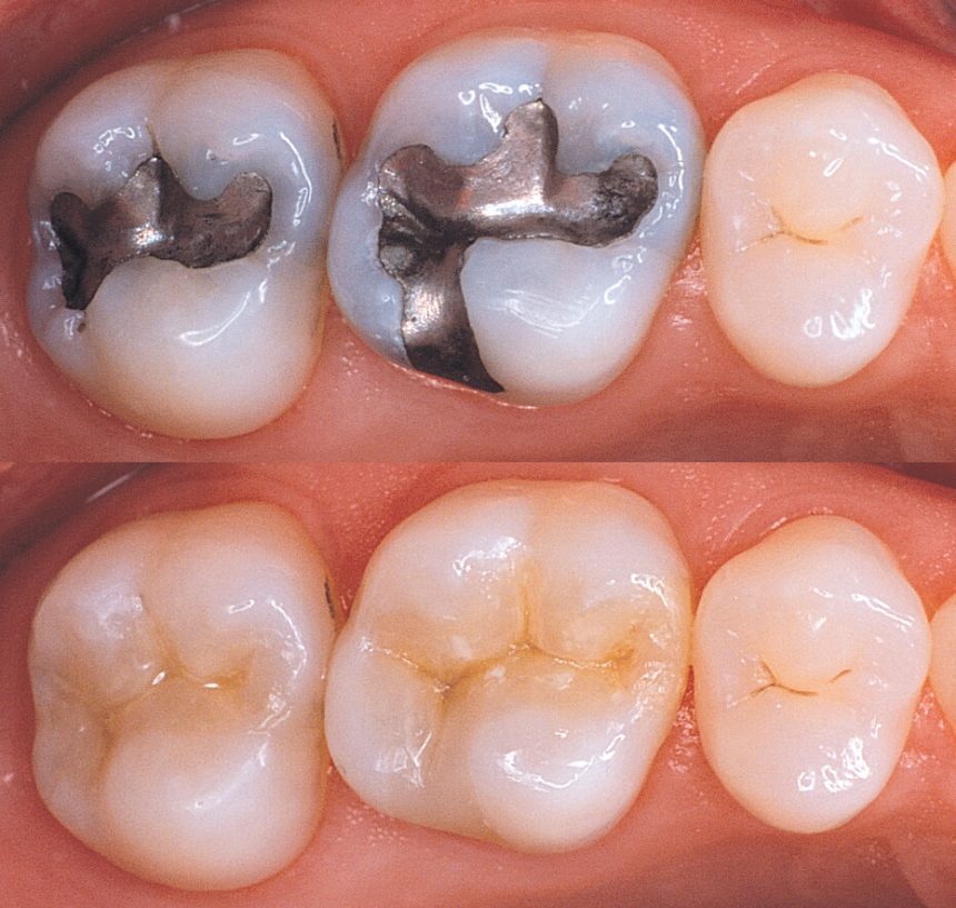 Fillings