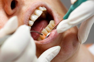 gum disease cardiff