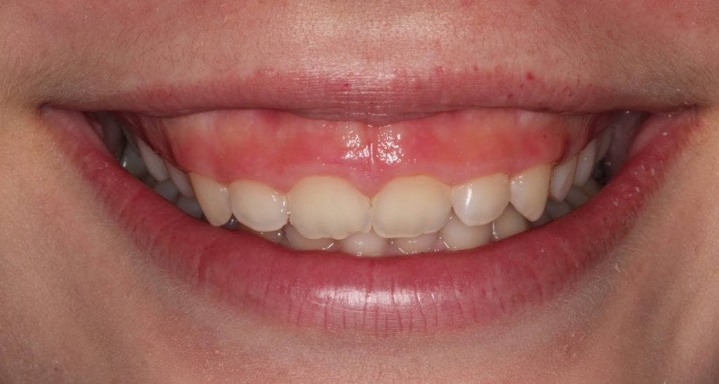MS Dental - Gummy Smile - Cardiff - Singleton - Fletcher - Newcastle