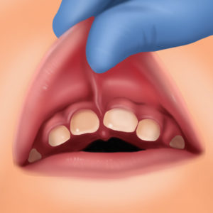 MS Dental - Lip Tie - Cardiff - Singleton - Fletcher - Newcastle