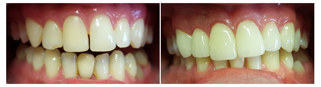 MS Dental - Porcelain Veneers - Cardiff - Singleton - Fletcher - Newcastle