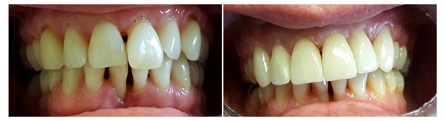 MS Dental - Porcelain Veneers - Cardiff - Singleton - Fletcher - Newcastle