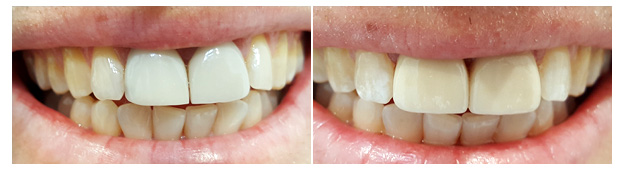 MS Dental - Porcelain Veneers - Cardiff - Singleton - Fletcher - Newcastle