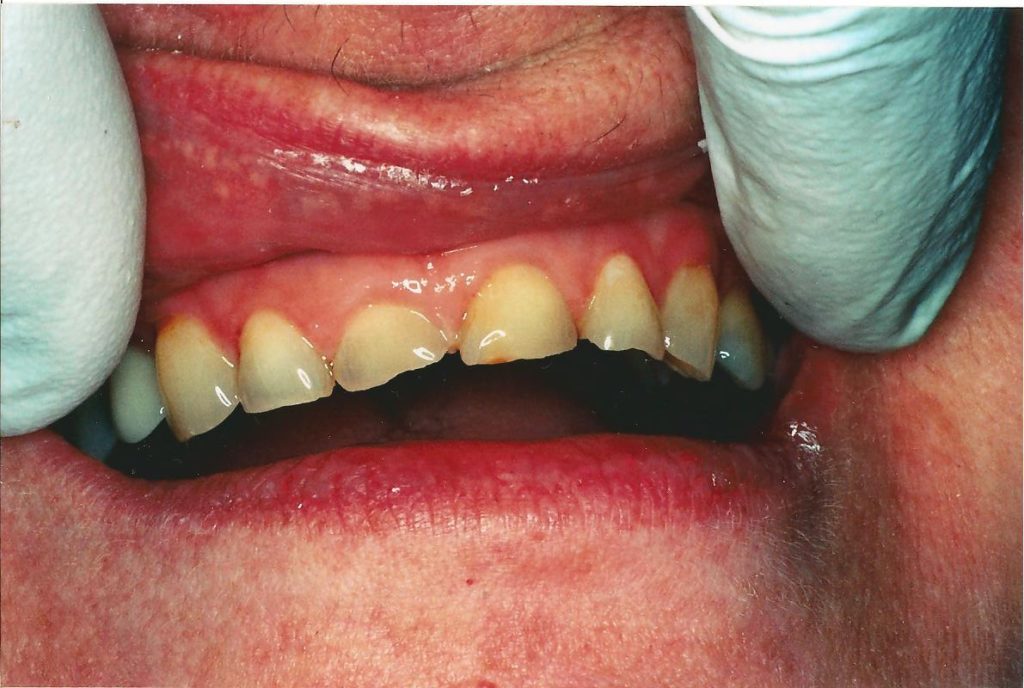 MS Dental - Short or Small Teeth - Cardiff - Singleton - Fletcher - Newcastle