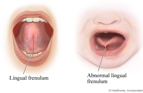 MS Dental - Tongue Tie - Cardiff - Singleton - Fletcher - Newcastle