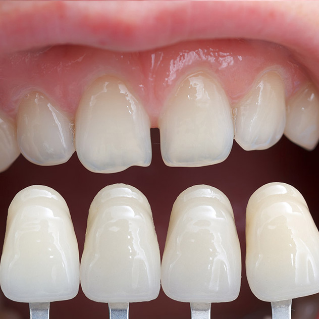 MS Dental - Veneers - Cardiff - Singleton - Fletcher - Newcastle