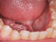 Tongue & Lip-Tie Removal