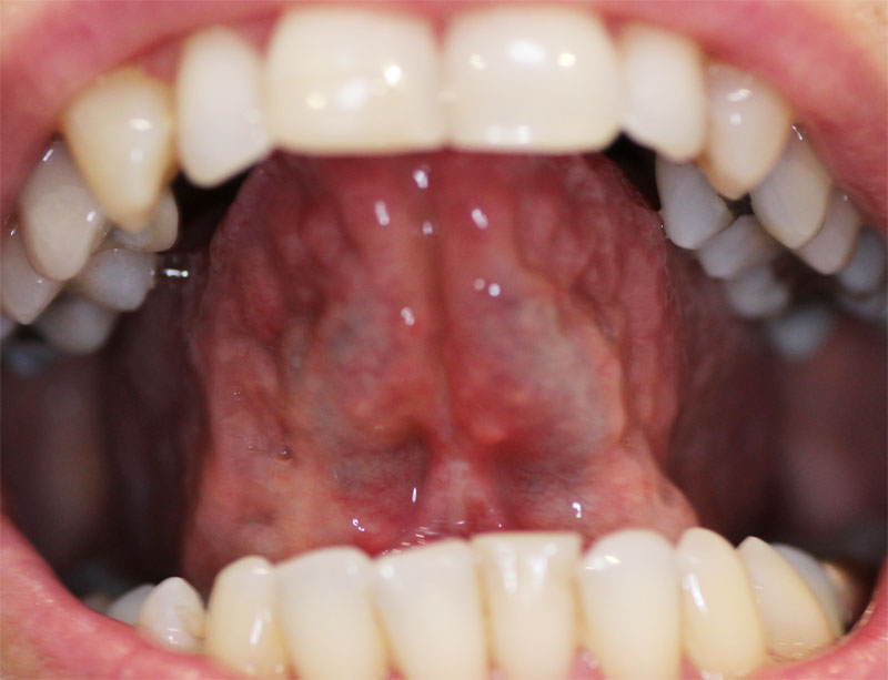 Tongue/Lip-Tie Removal