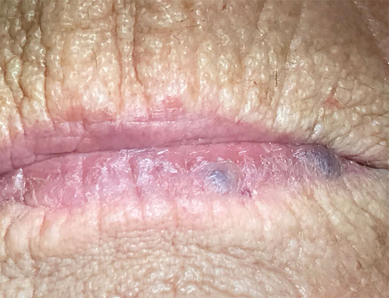 blood blister in mouth