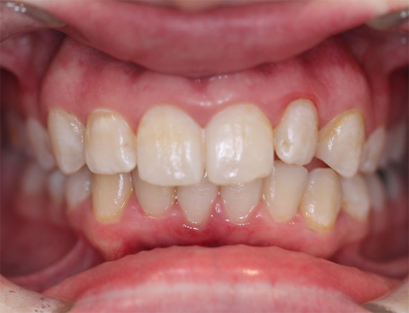 Clear Aligners