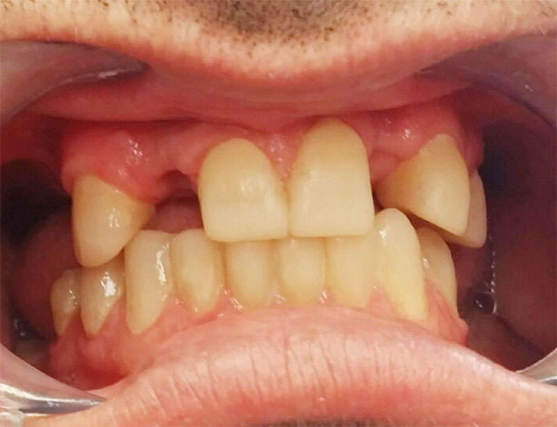 Dentures MsDental
