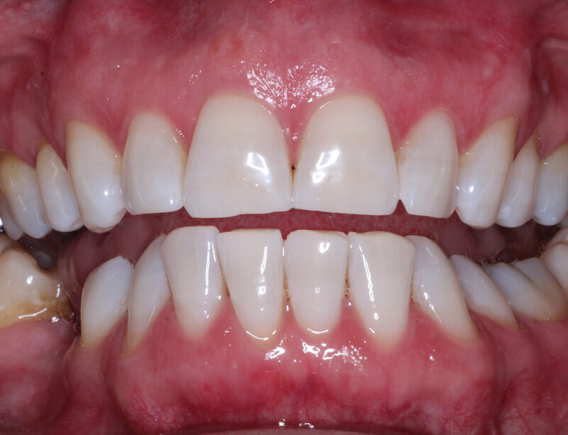 teeth whitening cardiff