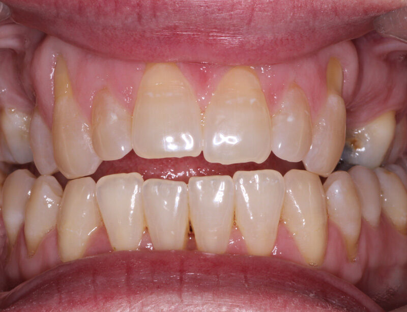 teeth whitening cardiff