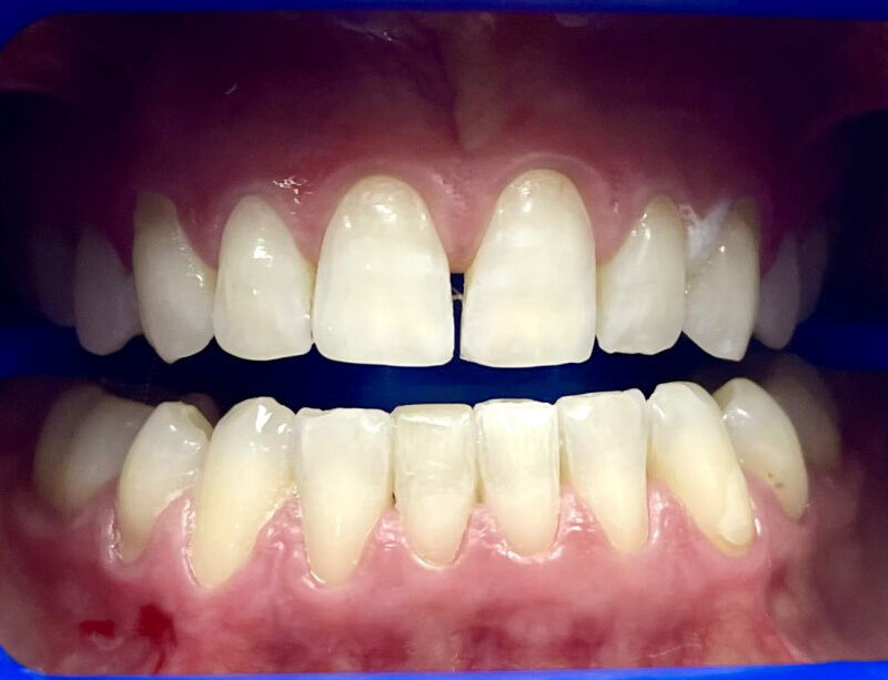 teeth whitening cardiff